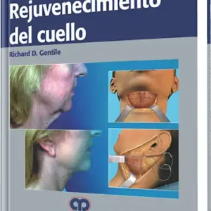 Rejuvenecimiento del Cuello