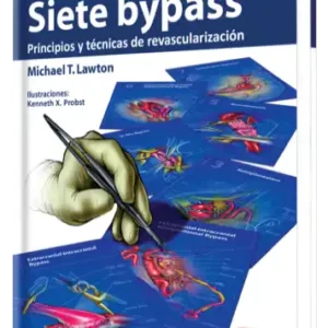 Siete Bypass Principios y Técnicas de Revascularización