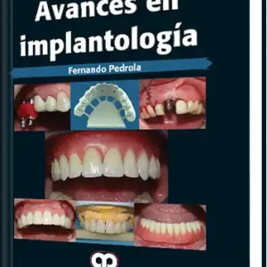 Avances en Implantología