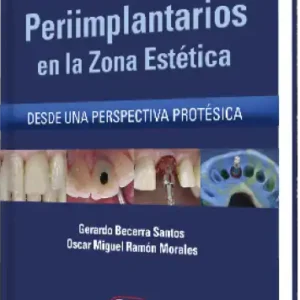 Manejo de Tejidos Periimplantarios en la Zona Estética