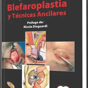 Blefaroplastia y Técnicas Ancilares