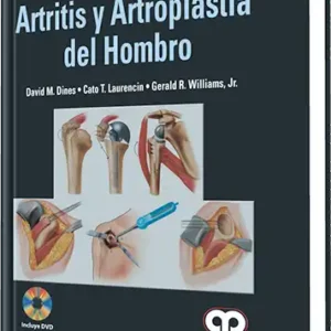 Artritis y Artroplastia del Hombro
