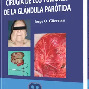 Cirugía de los Tumores de la Glándula Parótida
