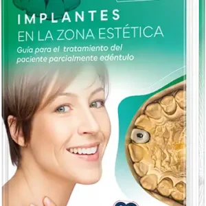 Implantes en la zona estética