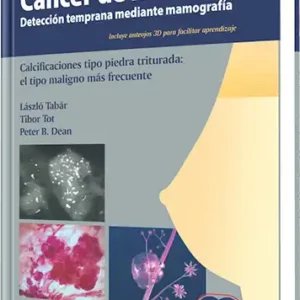 Cáncer de Mama Detección Temprana Mediante Mamografía