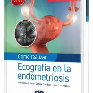 Cómo realizar Ecografía en la endometriosis
