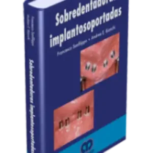 Sobredentaduras Implantosoportadas
