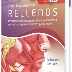 Complicaciones con Rellenos. Reacciones de hipersensibilidad, granulomas, necrosis y ceguera inducidos por rellenos