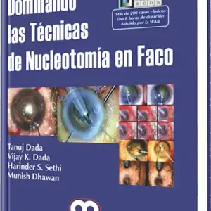Dominando las Técnicas de Nucleotomía en Faco