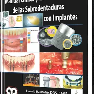 Manual Clínico y de Laboratorio de las Sobredentaduras con Implantes