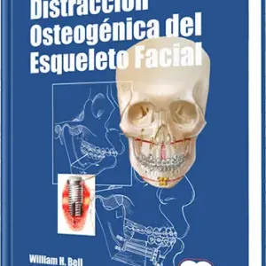 Distracción Osteogénica del Esqueleto Facial