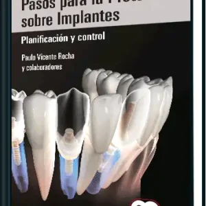 Pasos para la Prótesis Sobre Implantes