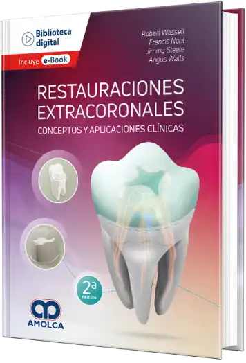 Restauraciones Extracoronales. Conceptos y Aplicaciones Clínicas
