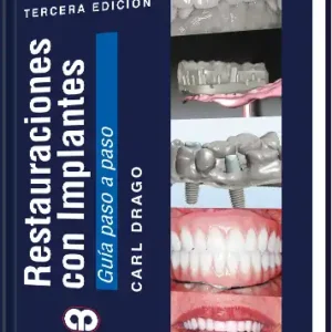 Restauraciones con Implantes. Guía Paso a Paso. 3 Edición